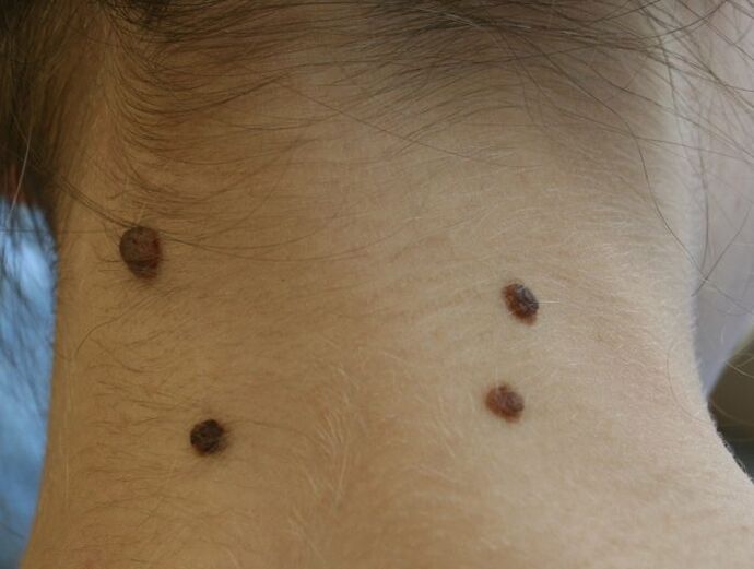 what do papillomas of the neck look like