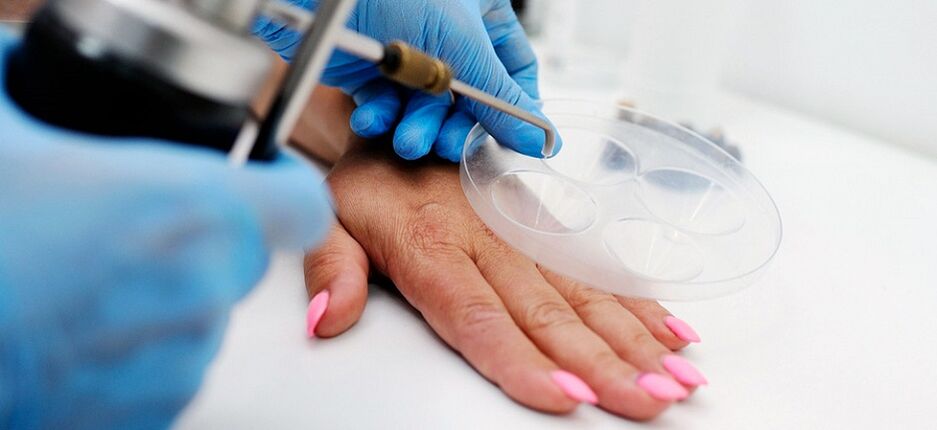 professional removal of warts on the hand