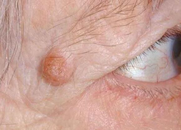 papilloma of the eyelid