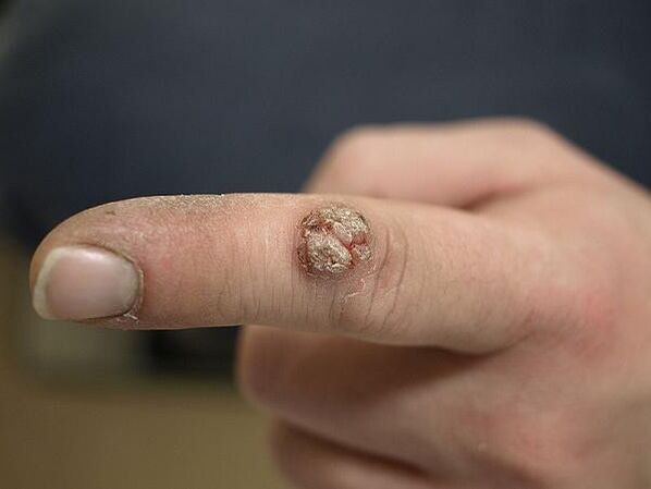 papilloma of the finger