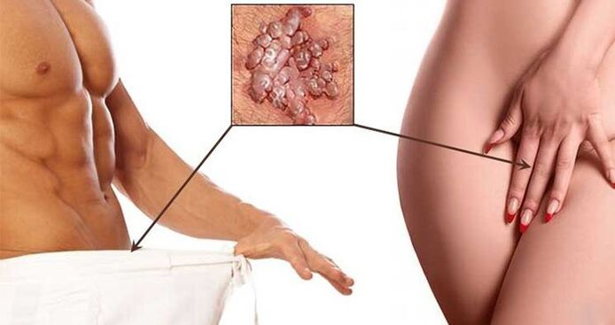 Genital warts in men and women