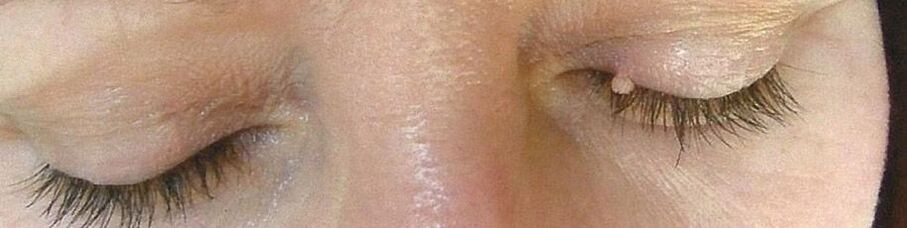 Papilloma of the eyelid