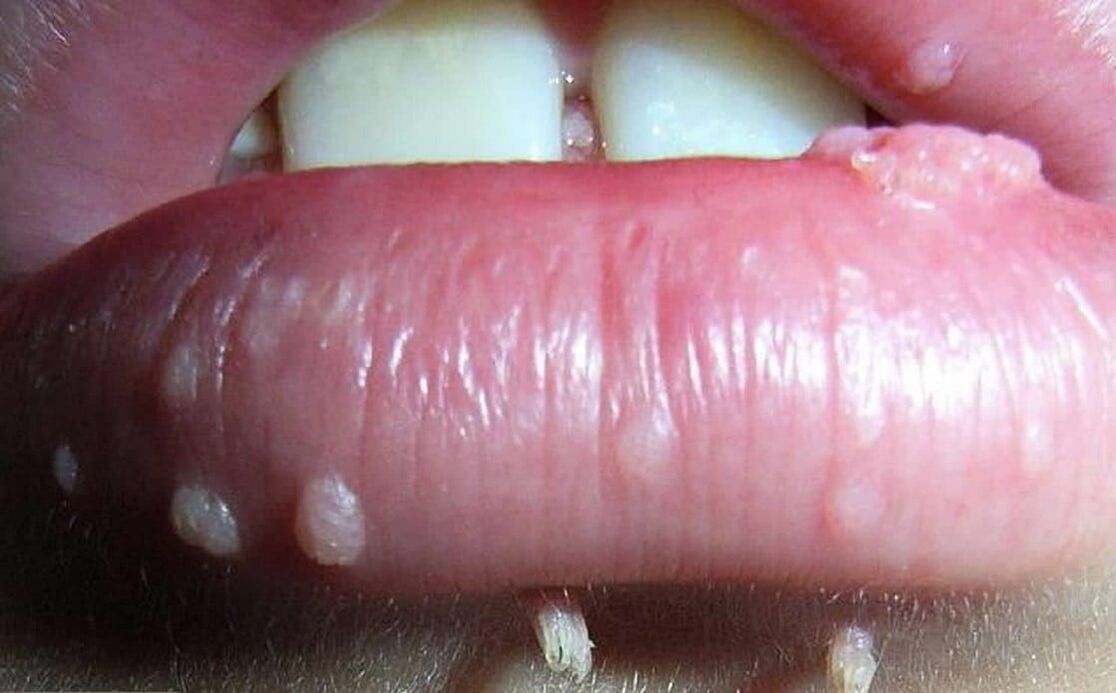Papillomas of the lips
