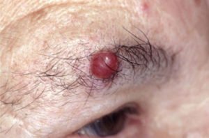 infection on the eyebrow