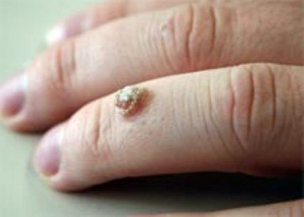 a wart on your finger
