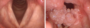 Hpv in the mouth