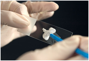 A Pap test human papilloma virus infection