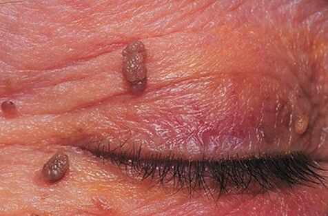 Papillomas on the skin of the eyelids, requiring treatment
